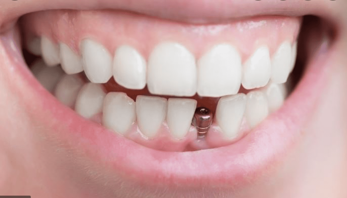 Mơ thấy rụng răng là hung hay cát? Mo thay rung rang la hung hay cat?